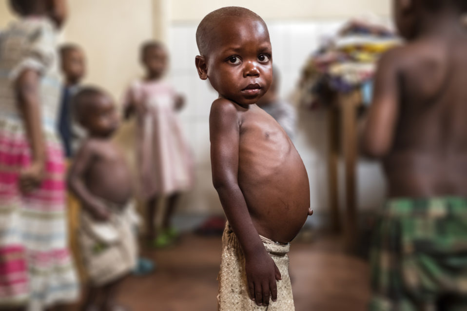 Bambino denutrito nel centro nutrizionale di Padre Querzani